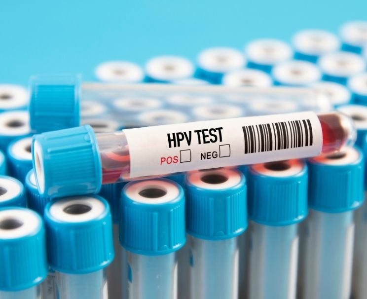 Where is an HPV Test Performed?